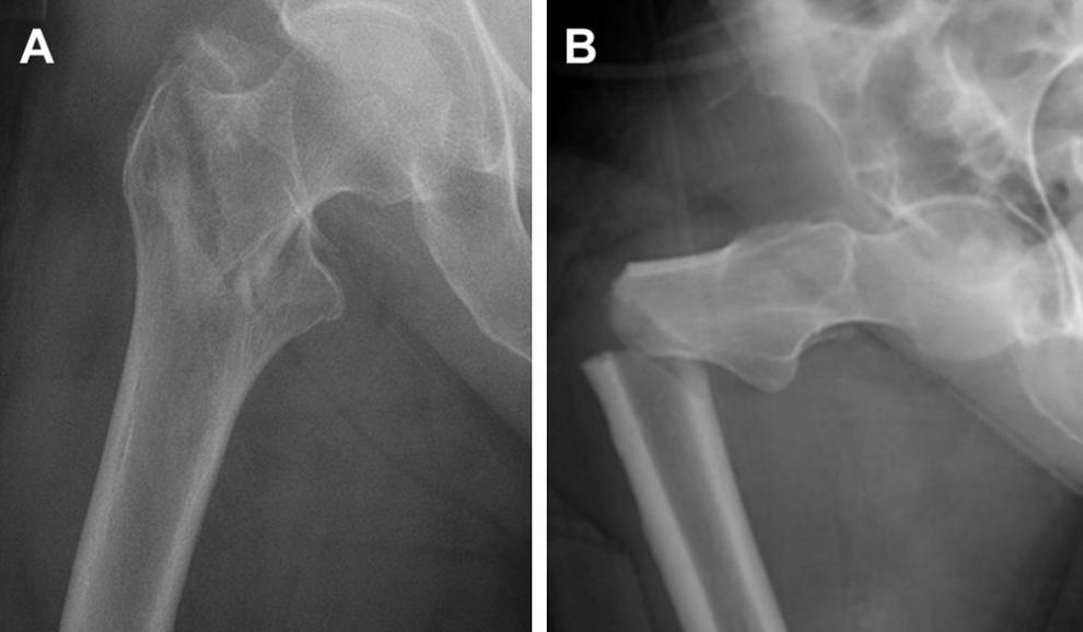 Hip Fracture Xray